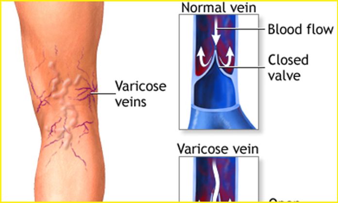 Varicose veins symptoms in telugu