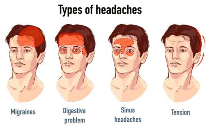 Types of headaches