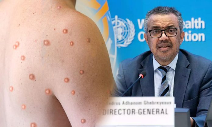 WHO declared health emergency due to Monkeypox